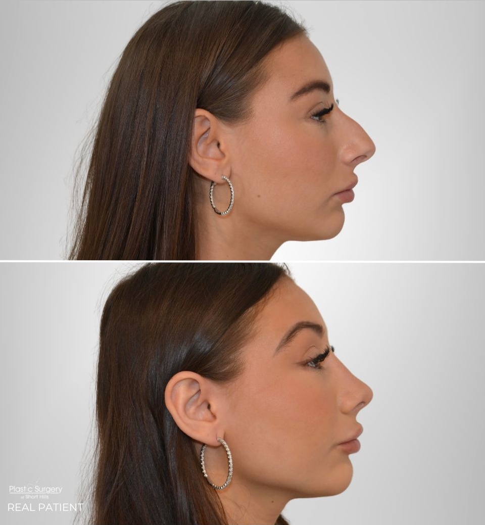 Face and Neck Rhinoplasty Surgery section background image