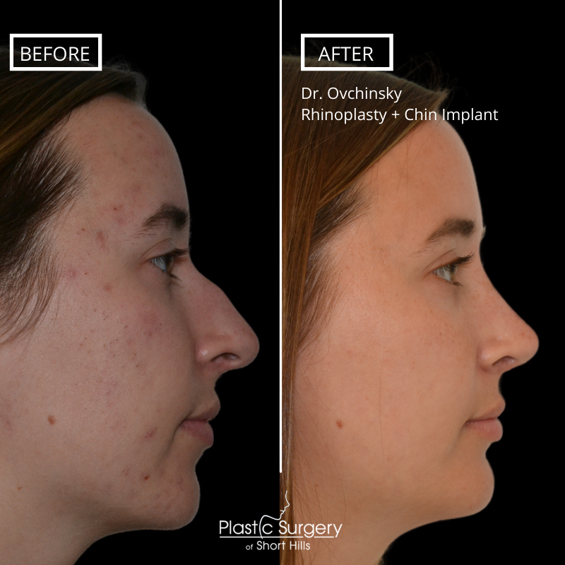 Choosing a Nose Shape and Nose Size when Considering Rhinoplasty