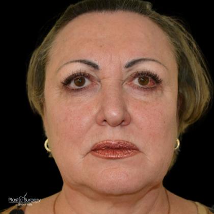 Facelift Before & After Patient #18060