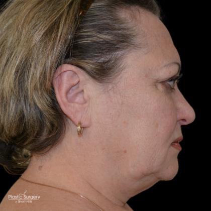 Facelift Before & After Patient #18060