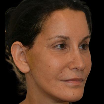 Facelift Before & After Patient #18059