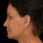 Facelift Before & After Patient #18059