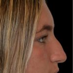 Rhinoplasty Before & After Patient #18352