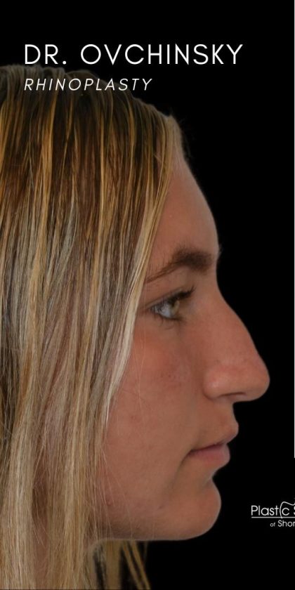 Rhinoplasty Before & After Patient #18352