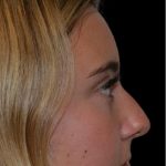 Rhinoplasty Before & After Patient #18353