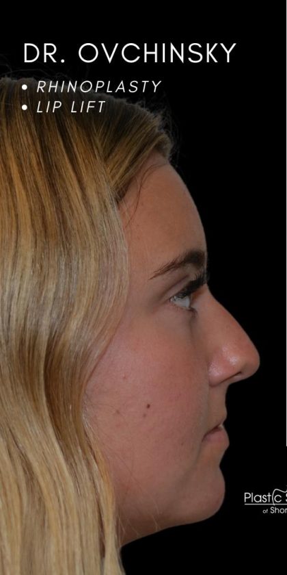 Rhinoplasty Before & After Patient #18353