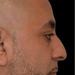 Rhinoplasty Before & After Patient #18351