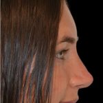 Rhinoplasty Before & After Patient #18352
