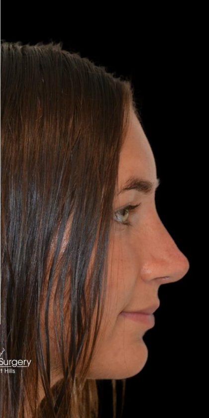 Rhinoplasty Before & After Patient #18352