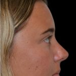 Rhinoplasty Before & After Patient #18353