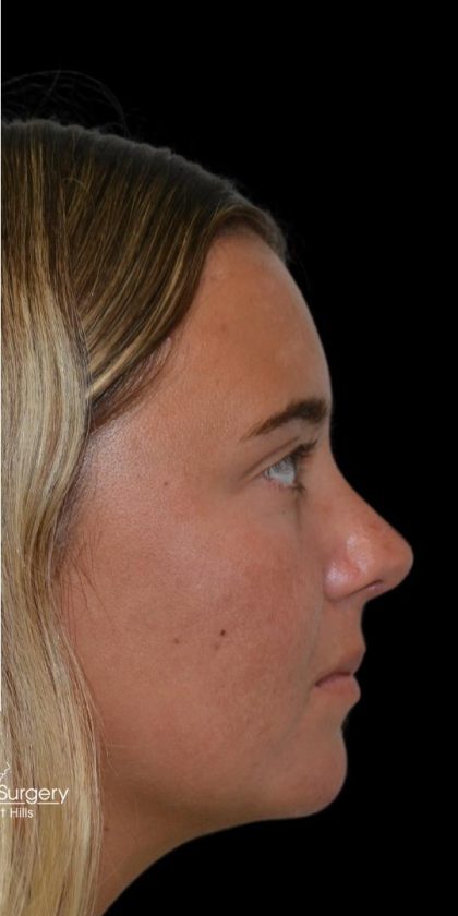 Rhinoplasty Before & After Patient #18353