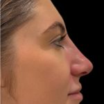 Liquid Rhinoplasty(Non-Surgical) Before & After Patient #18265