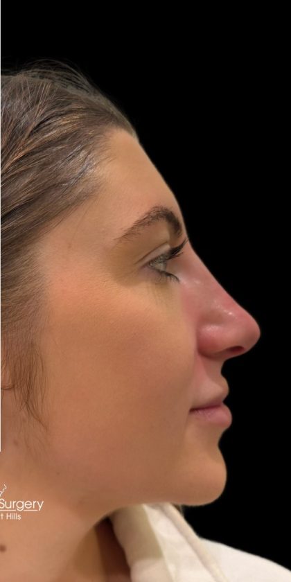 Liquid Rhinoplasty(Non-Surgical) Before & After Patient #18265