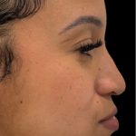 Liquid Rhinoplasty(Non-Surgical) Before & After Patient #18264