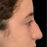 Rhinoplasty Before & After Patient #18270
