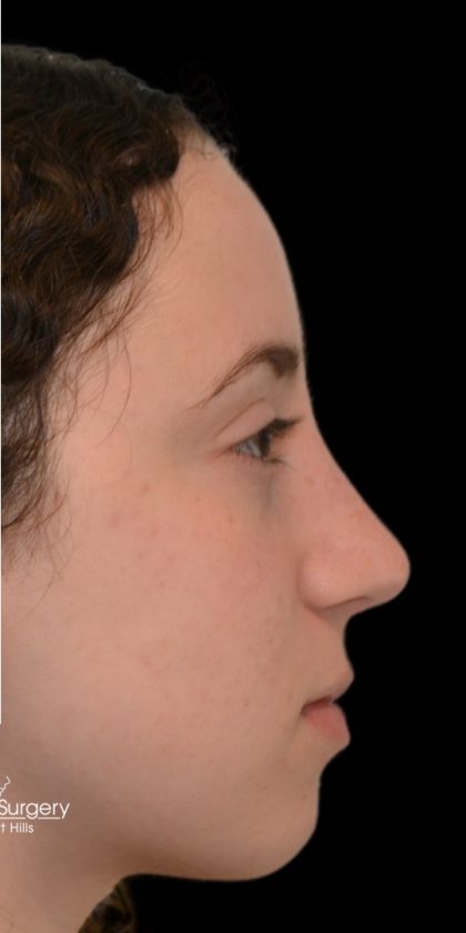 Rhinoplasty Before & After Patient #18270