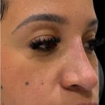 Liquid Rhinoplasty(Non-Surgical) Before & After Patient #18264