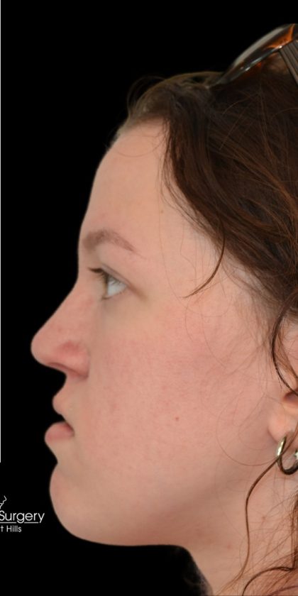 Rhinoplasty Before & After Patient #18263
