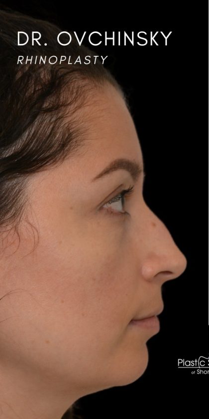 Rhinoplasty Before & After Patient #18269