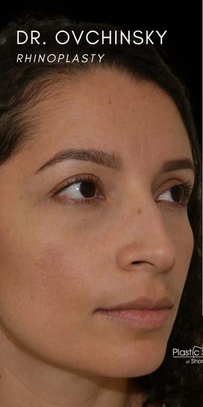 Rhinoplasty Before & After Patient #18269