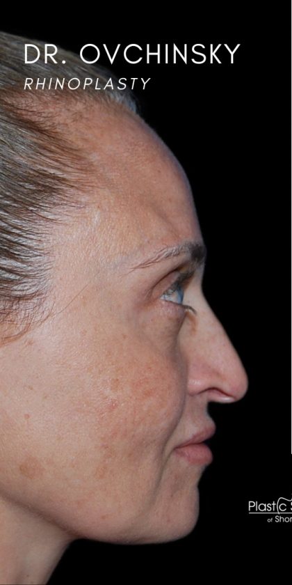 Rhinoplasty Before & After Patient #18267