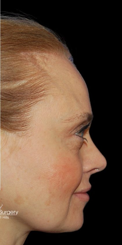 Rhinoplasty Before & After Patient #18267