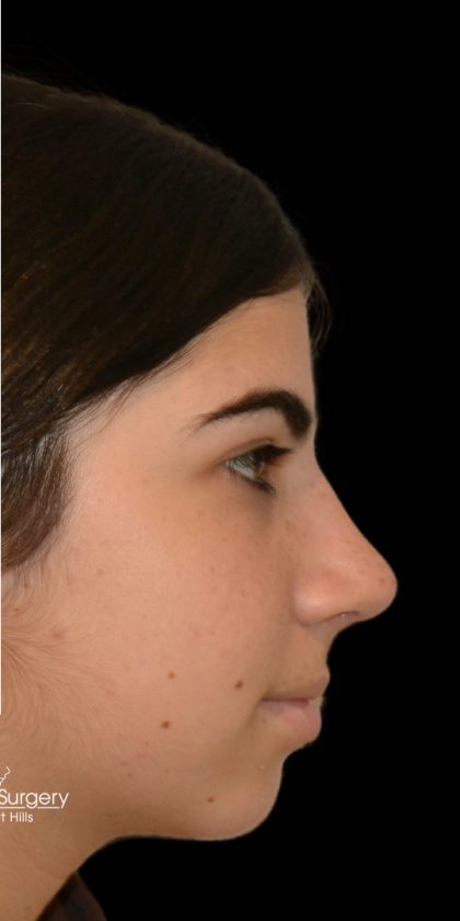 Rhinoplasty Before & After Patient #18266