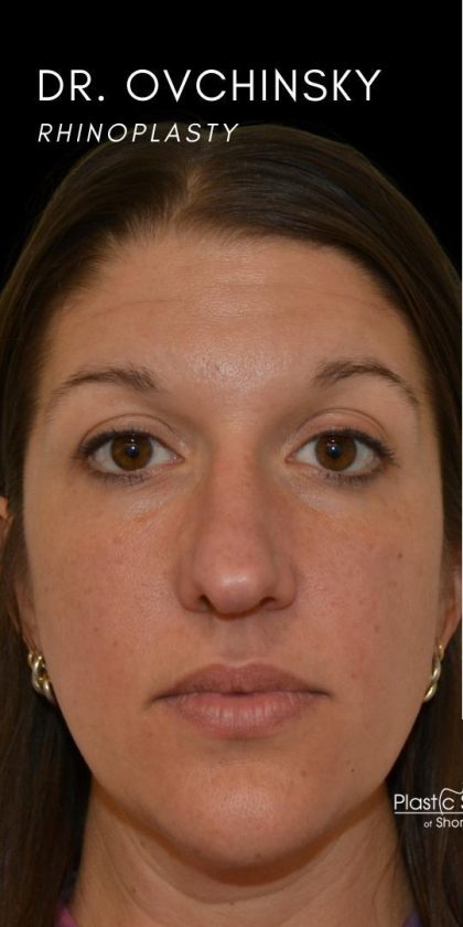 Rhinoplasty Before & After Patient #18464