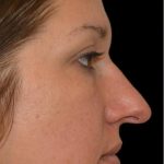 Rhinoplasty Before & After Patient #18464