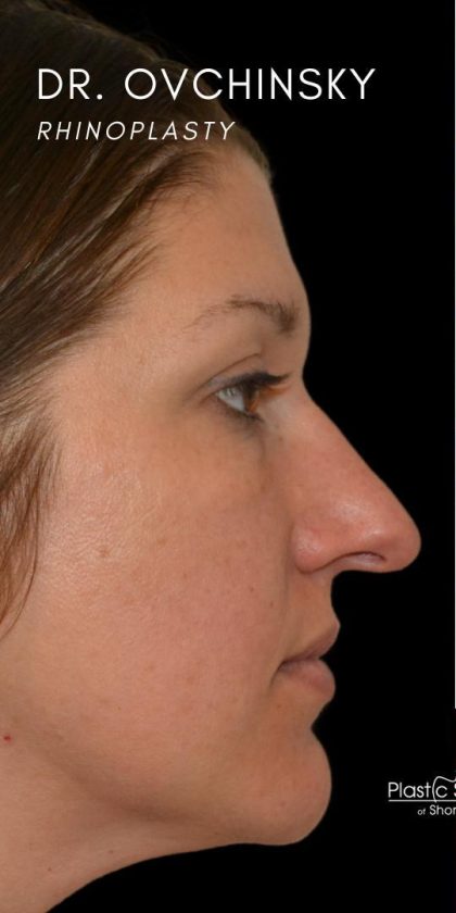 Rhinoplasty Before & After Patient #18464