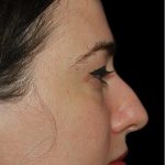 Rhinoplasty Before & After Patient #18475