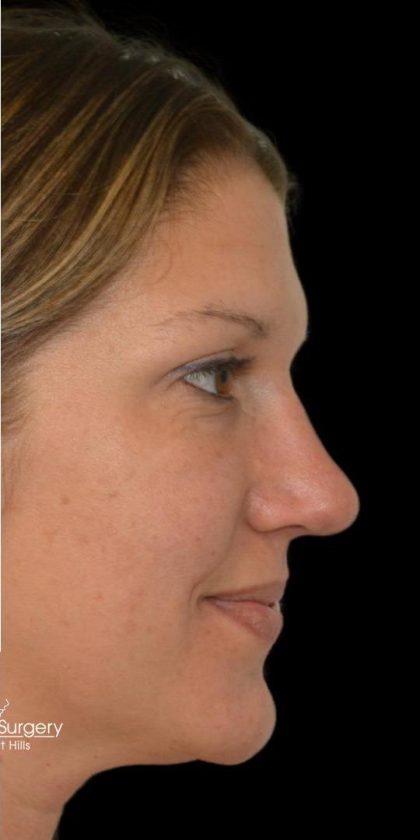 Rhinoplasty Before & After Patient #18464