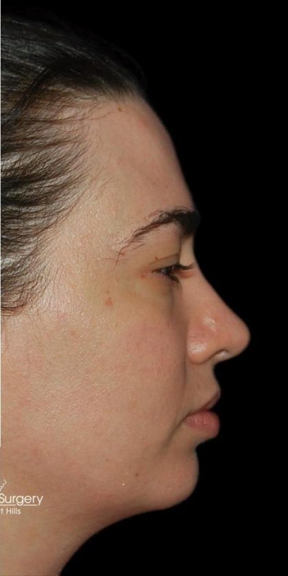 Rhinoplasty Before & After Patient #18475
