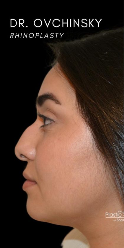 Rhinoplasty Before & After Patient #18555