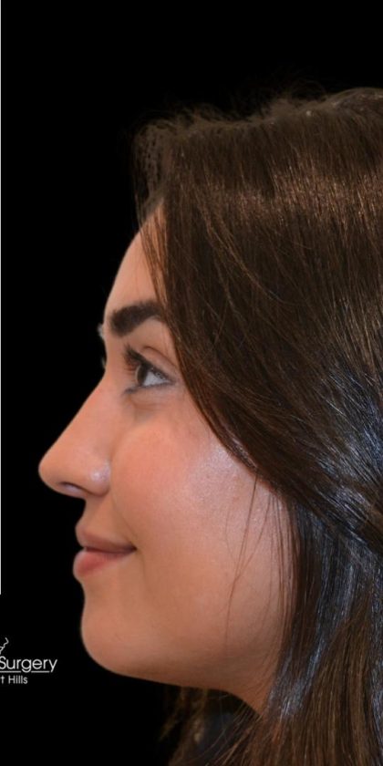 Rhinoplasty Before & After Patient #18555