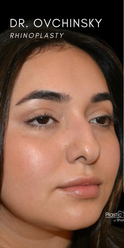 Rhinoplasty Before & After Patient #18555