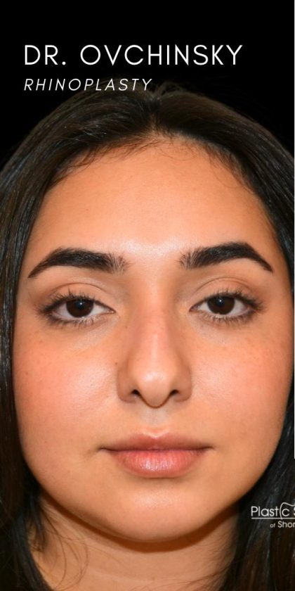 Rhinoplasty Before & After Patient #18555