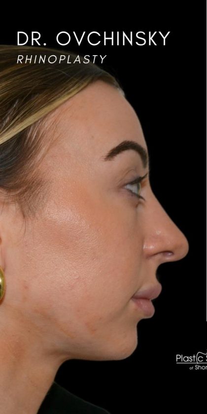 Rhinoplasty Before & After Patient #18557