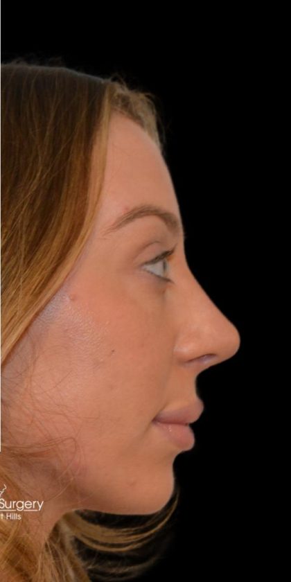 Rhinoplasty Before & After Patient #18557