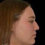 Rhinoplasty Before & After Patient #18937