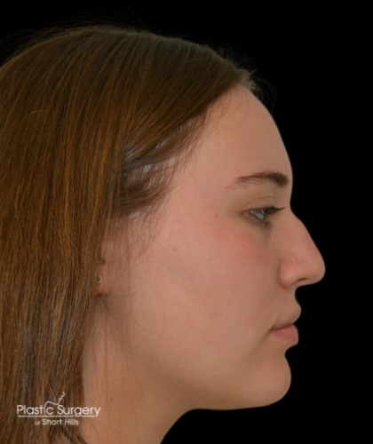 Rhinoplasty Before & After Patient #18937