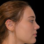 Rhinoplasty Before & After Patient #18937