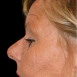 Rhinoplasty Before & After Patient #18728