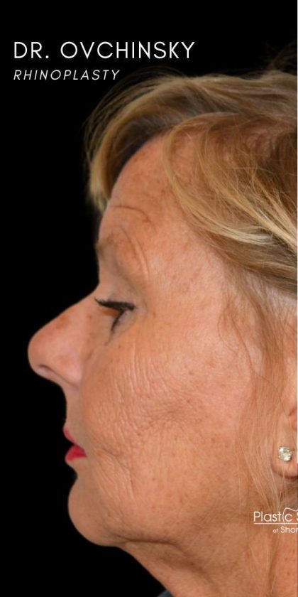 Rhinoplasty Before & After Patient #18728