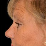 Rhinoplasty Before & After Patient #18728