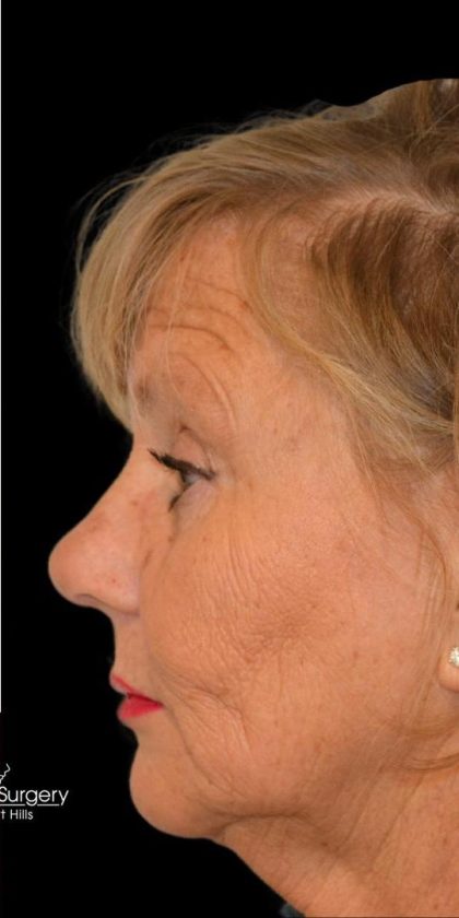 Rhinoplasty Before & After Patient #18728