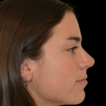 Rhinoplasty Before & After Patient #19148