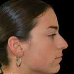 Rhinoplasty Before & After Patient #19148