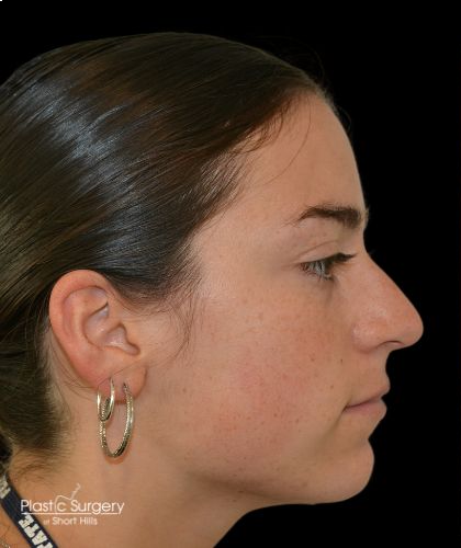 Rhinoplasty Before & After Patient #19148