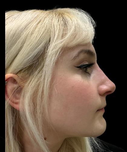 Liquid Rhinoplasty(Non-Surgical) Before & After Patient #19227